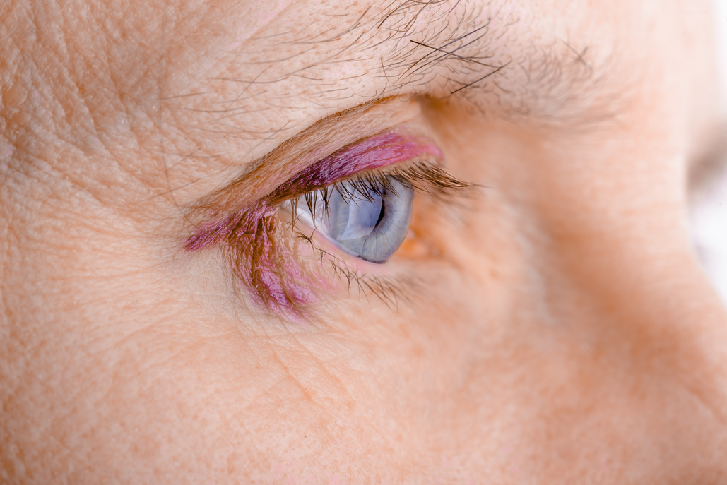 Eye injury settlements