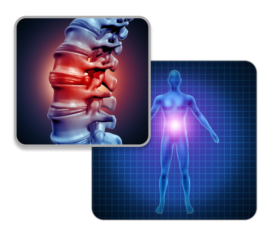 Santa Rosa spinal cord injury attorney