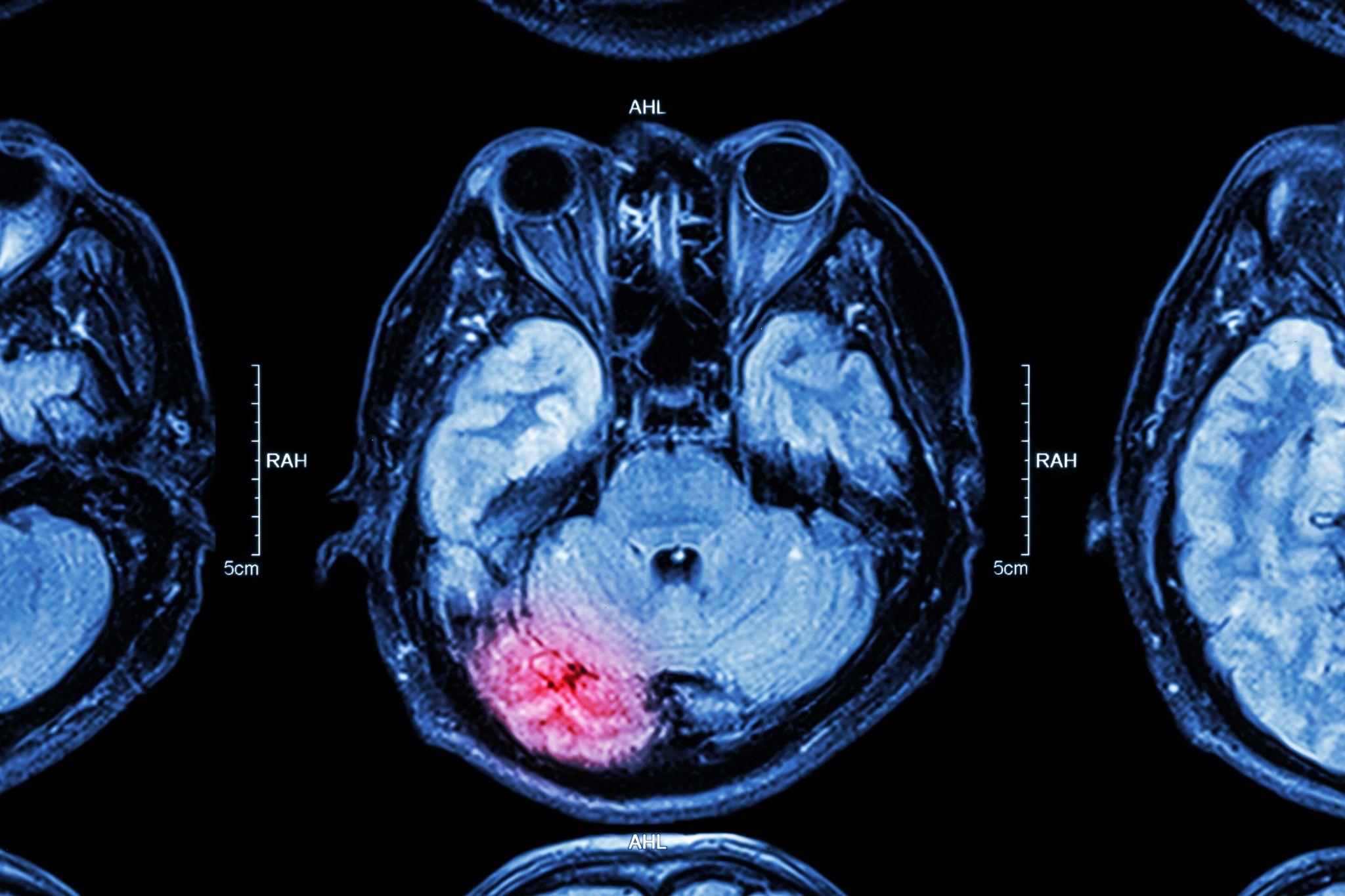 Brain Injury